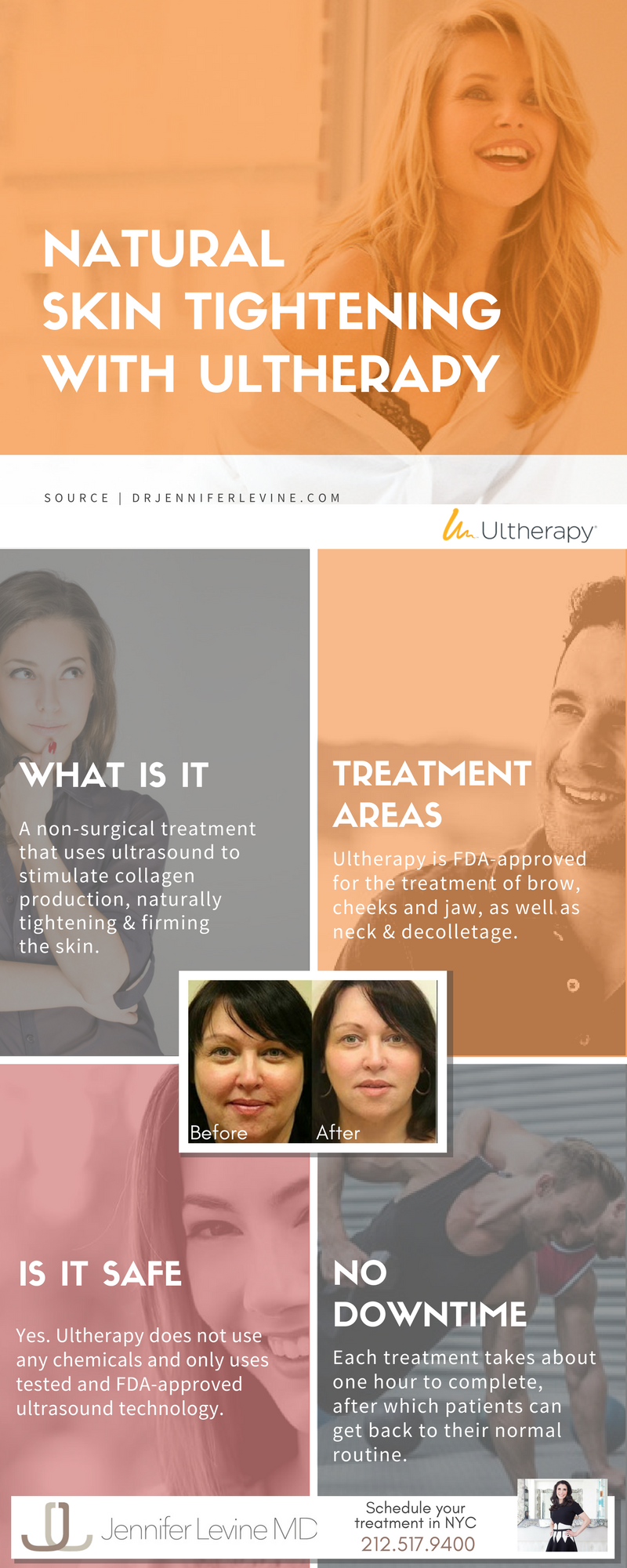 Skin tightening with ultherapy