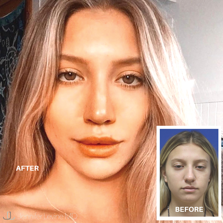 Rhinoplasty Surgery Before and After Photos
