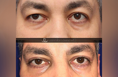 blepharoplasty