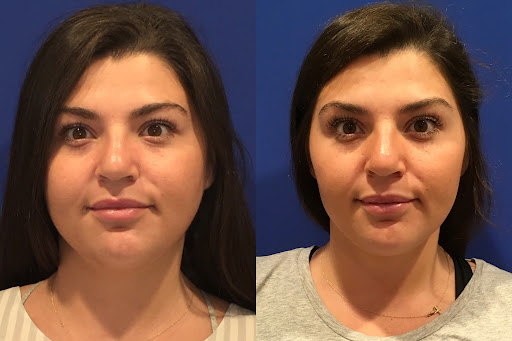 Kybella vs. CoolSculpting BNA