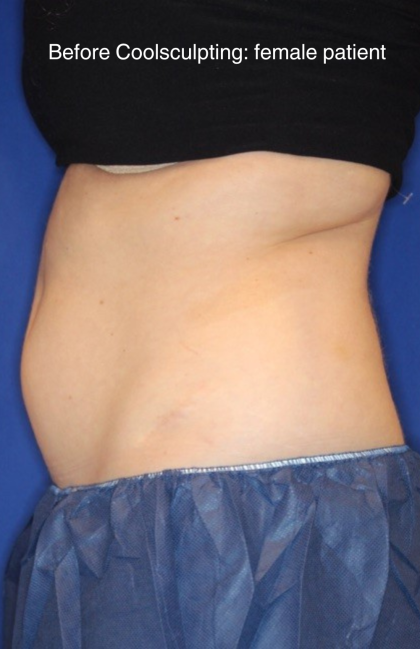 CoolSculpting Elite Before & After Patient #15810