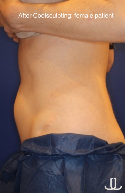 CoolSculpting Elite Before & After Patient #15810