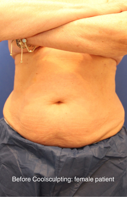 CoolSculpting Elite Before & After Patient #14207