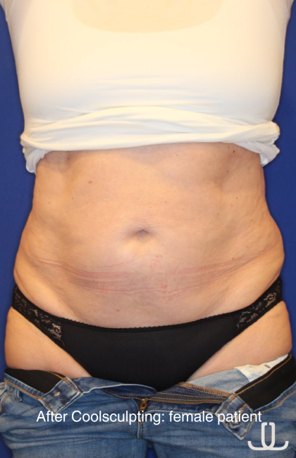 CoolSculpting Elite Before & After Patient #14207