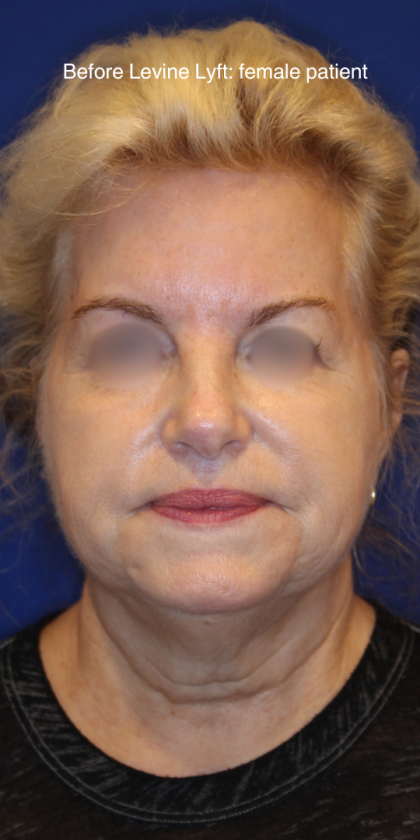 Facelift / Neck Lift Before & After Patient #15692