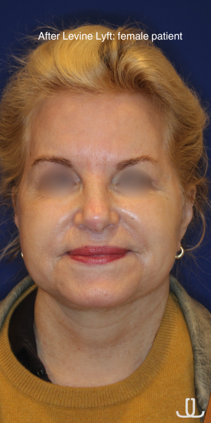 Facelift / Neck Lift Before & After Patient #15692