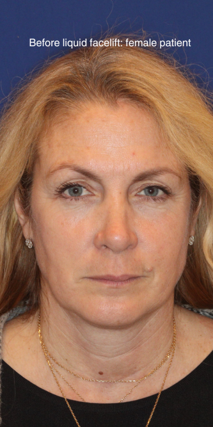 Liquid Facelift Before & After Patient #15788