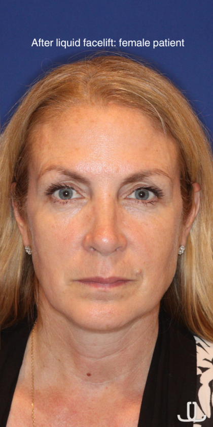 Liquid Facelift Before & After Patient #15788