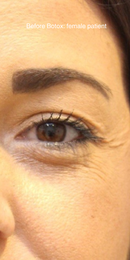 Botox & Wrinkle Relaxers Before & After Patient #15140