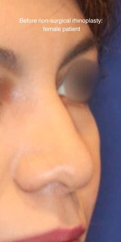 Non-Surgical Nose Job Before & After Patient #15149