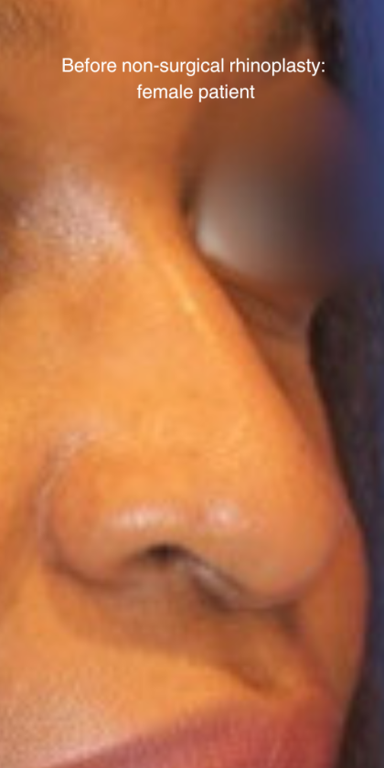 Non-Surgical Nose Job Before & After Patient #13876