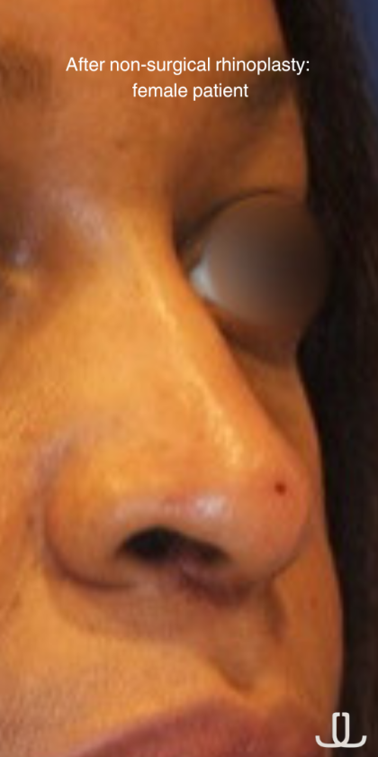 Non-Surgical Nose Job Before & After Patient #13876