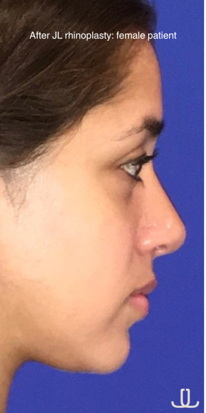 Patient #13751 Rhinoplasty Before and After Photos New York, NY ...