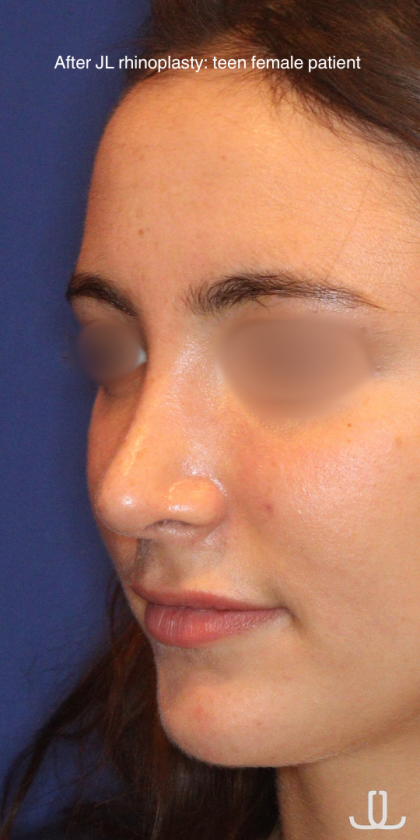 Rhinoplasty Before & After Patient #15186