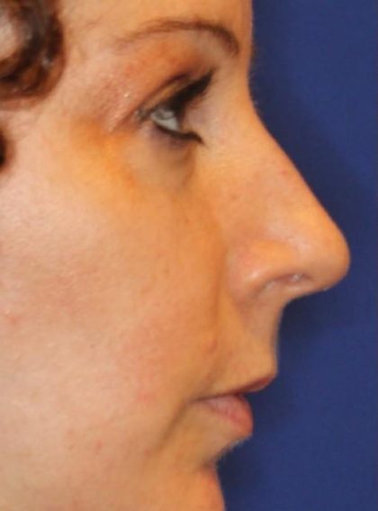 Septoplasty Before & After Patient #13556