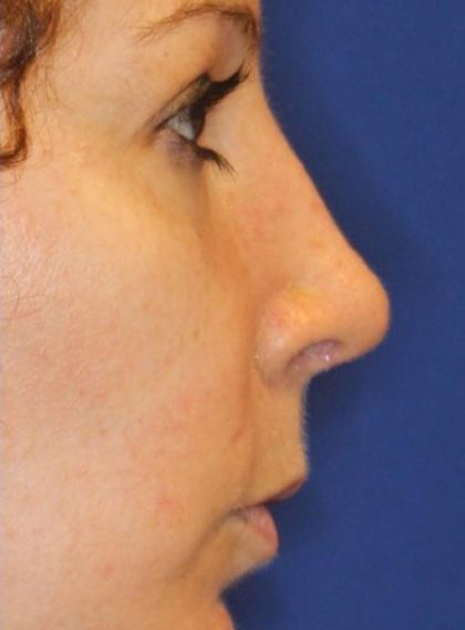 Septoplasty Before & After Patient #13556