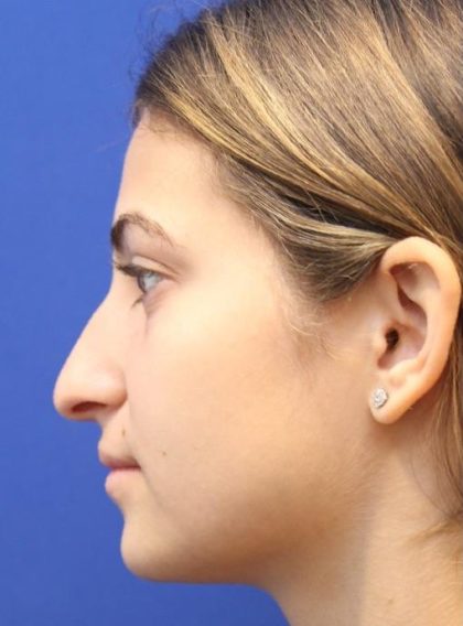 Septoplasty Before & After Patient #13549