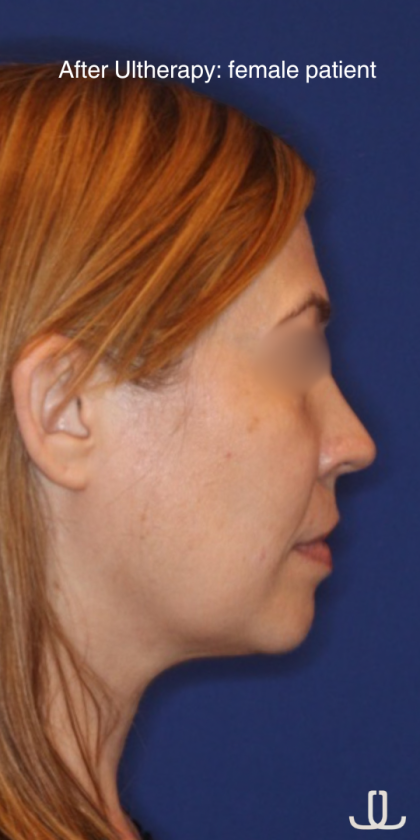 Ultherapy Before & After Patient #15607