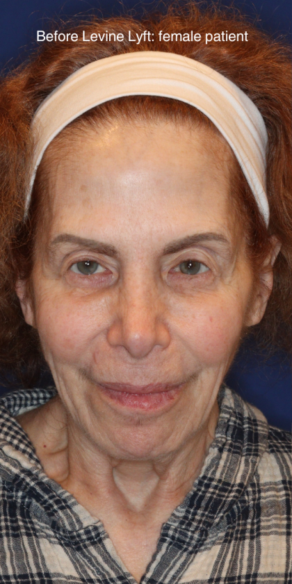 Facelift / Neck Lift Before & After Patient #15094