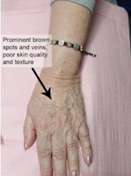Hand Rejuvenation Before & After Patient #14188