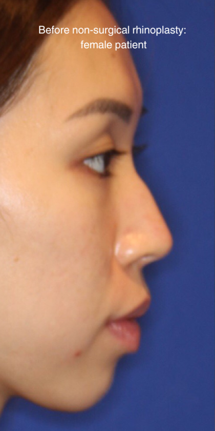 Non-Surgical Nose Job Before & After Patient #13883