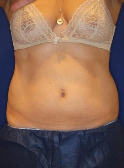 Body Contouring Before & After Patient #14235