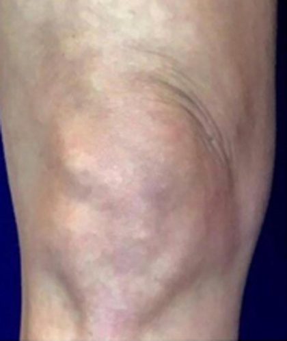 Knee Tightening Before & After Patient #14189