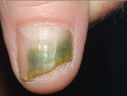 Nail Fungus Removal Before & After Patient #14195