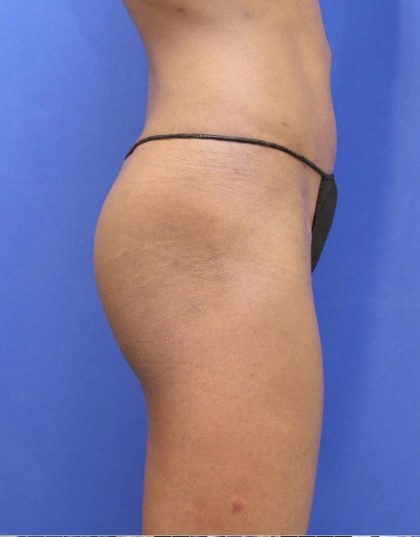 Non-Surgical Butt Lift Before & After Patient #14179