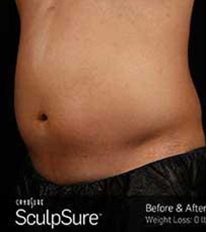 Sculpsure Before & After Patient #14200