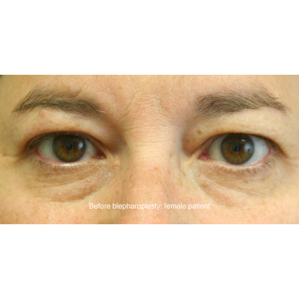 Blepharoplasty Before & After Patient #15010