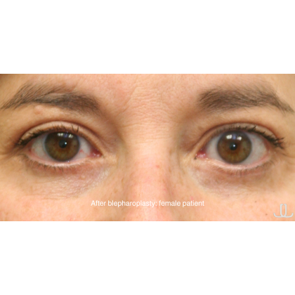 Blepharoplasty Before & After Patient #15010