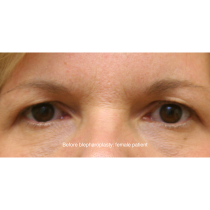 Blepharoplasty Before & After Patient #15008