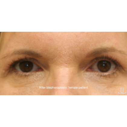 Blepharoplasty Before & After Patient #15008