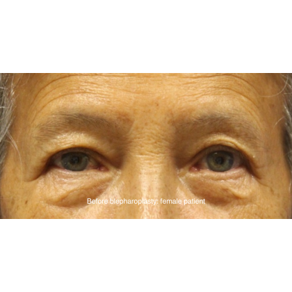 Blepharoplasty Before & After Patient #15664