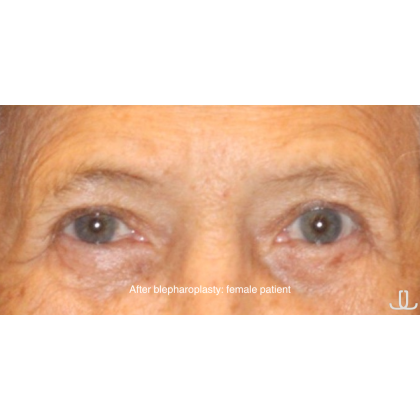 Blepharoplasty Before & After Patient #15664