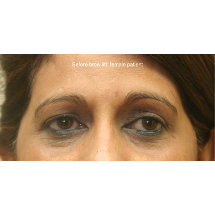 Brow Lift Before & After Patient #15807