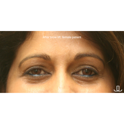 Brow Lift Before & After Patient #15807