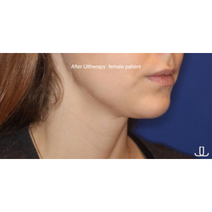 Double Chin Fat Removal Before & After Patient #13846