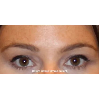 Botox & Wrinkle Relaxers Before & After Patient #15133