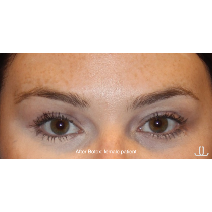 Botox & Wrinkle Relaxers Before & After Patient #15133