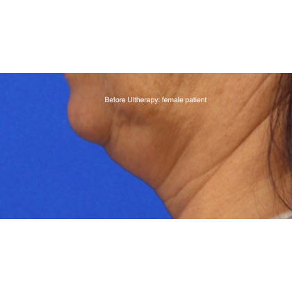 Ultherapy Before & After Patient #15605