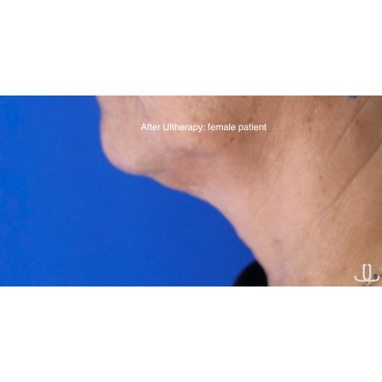 Ultherapy Before & After Patient #15605