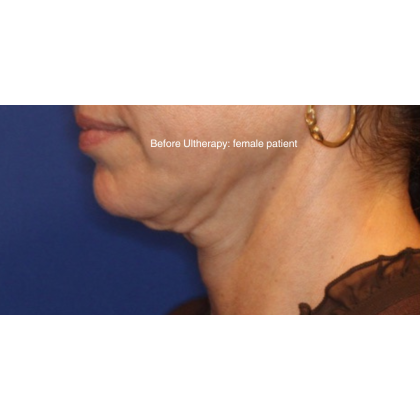 Ultherapy Before & After Patient #15604