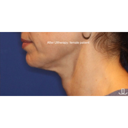 Ultherapy Before & After Patient #15604