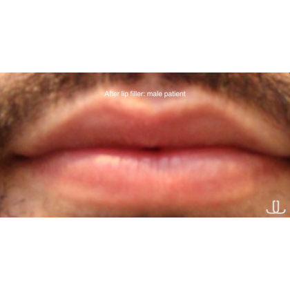 Dermal Fillers Before & After Patient #15711