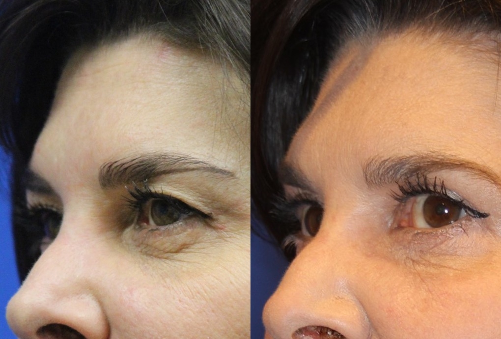 Combined Blepharoplasty Featured