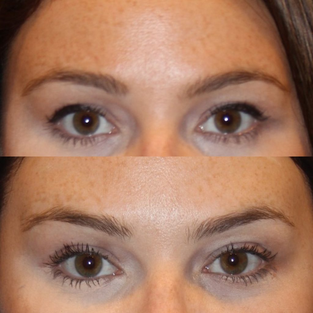 Non Surgical Botox Brow Lift Featured