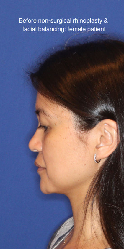 Non-Surgical Nose Job Before & After Patient #16197