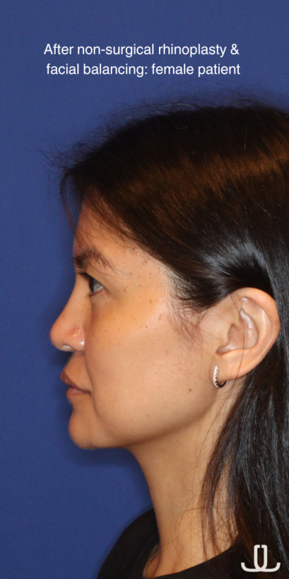 Non-Surgical Nose Job Before & After Patient #16197